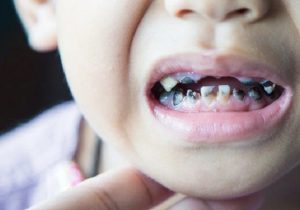 چرا دندان کودکان سیاه میشود؟