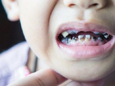 چرا دندان کودکان سیاه میشود؟